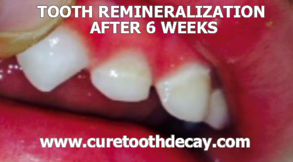 baby tooth remineralization after 6 weeks