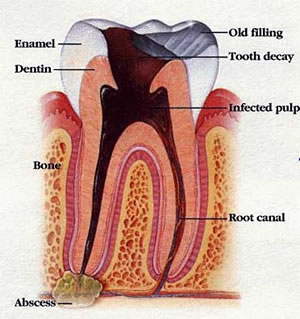 Tooth Infection Image